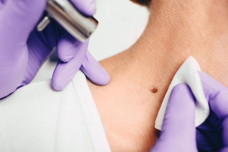 Borttagning av leverfläck